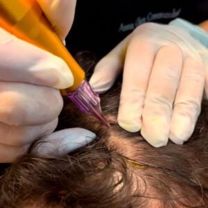 MMP-Microinfusão-de-Medicamentos-na-Pele