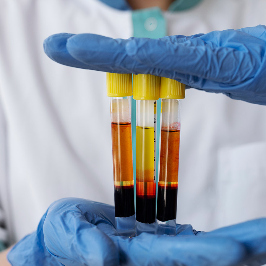 Plasma-Rico-em-Plaquetas