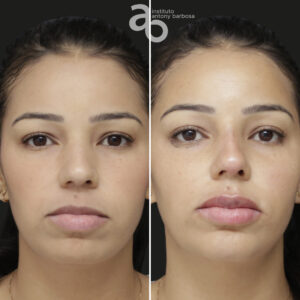Perfiloplastia 2 quadrado _ Poliana-1