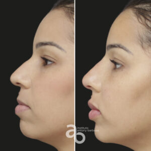 Perfiloplastia 2 quadrado _ Poliana-3