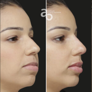 Perfiloplastia 2 quadrado _ Poliana-4