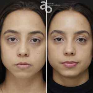 Perfiloplastia 6 quadrado _ Bárbara-1