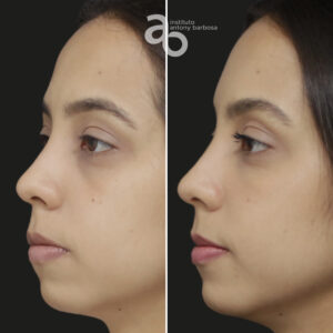 Perfiloplastia 6 quadrado _ Bárbara-2