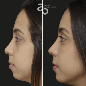 Perfiloplastia 6 quadrado _ Bárbara-3