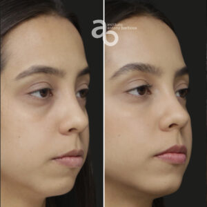 Perfiloplastia 6 quadrado _ Bárbara-4