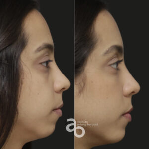 Perfiloplastia 6 quadrado _ Bárbara-5